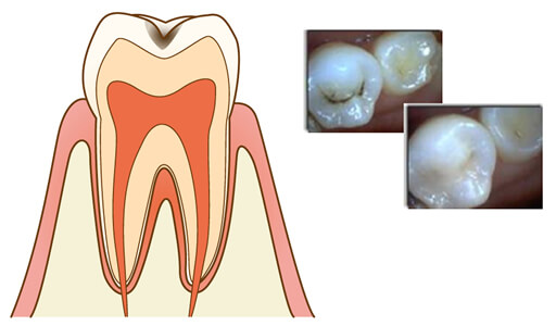板橋ステーション歯科の虫歯治療