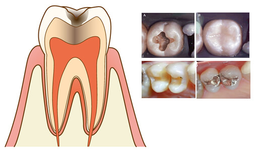 板橋ステーション歯科の虫歯治療