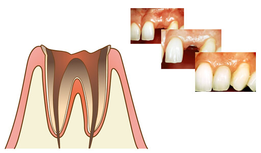 板橋ステーション歯科の虫歯治療