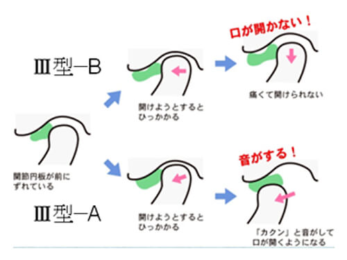 板橋ステーション歯科の噛み合わせ