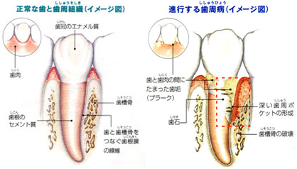板橋ステーション歯周外科