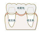 インプラント治療