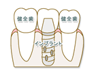 インプラント治療