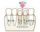 インプラント治療