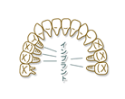 インプラント治療