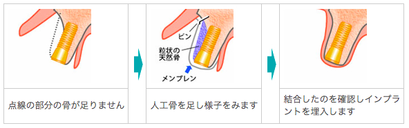 板橋ステーション歯科のインプラント