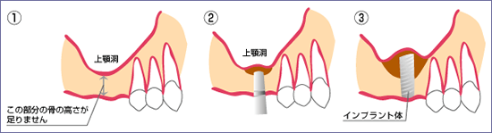 板橋ステーション歯科のインプラント