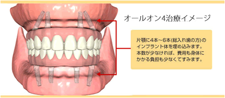 板橋ステーション歯科のインプラント