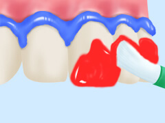 板橋ステーション歯科のホワイトニング