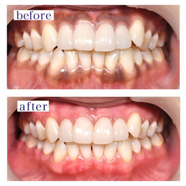 板橋ステーション歯科のホワイトニング